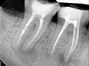 Digital X-ray of a tooth