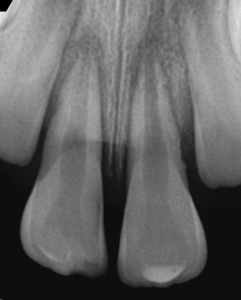 Digital X-ray of a tooth
