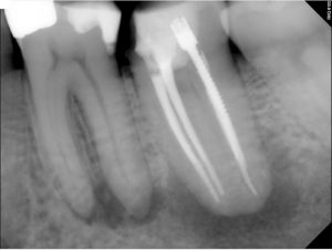 Digital X-ray of a tooth