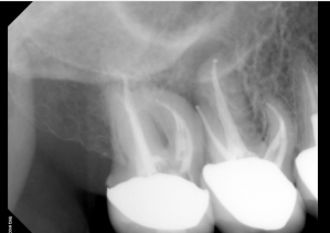 Digital X-ray of a tooth