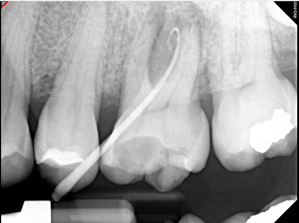 Digital X-ray of a tooth
