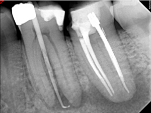 Digital X-ray of a tooth