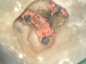 Image of a damaged tooth