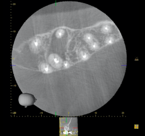CBCT Scanner image of multiple problem roots