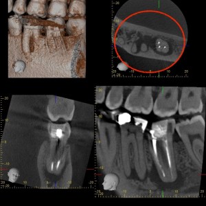 CBCT Scanner image of lesion on a tooth