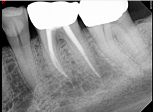Digital X-ray of a tooth