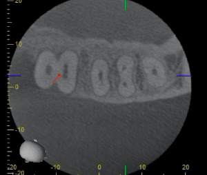 Digital X-ray of a tooth