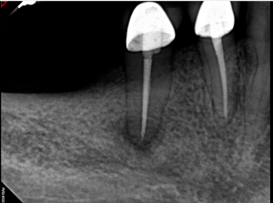 Digital X-ray of a tooth