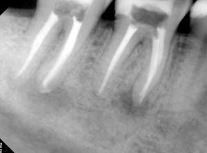 Digital X-ray of a tooth