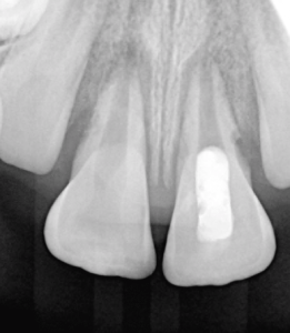 Digital X-ray of a tooth