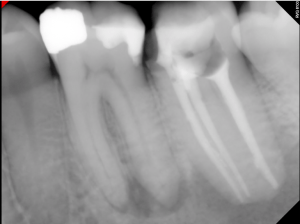 Digital X-ray of a tooth
