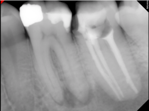 Digital X-ray of a tooth