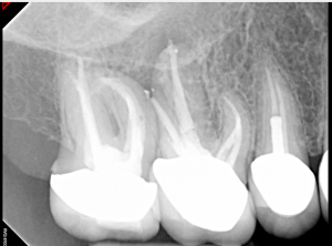 Digital X-ray of a tooth
