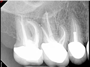 Digital X-ray of a tooth