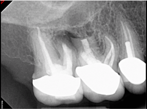Digital X-ray of a tooth