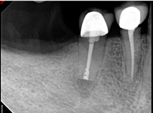 Galería de endodoncia