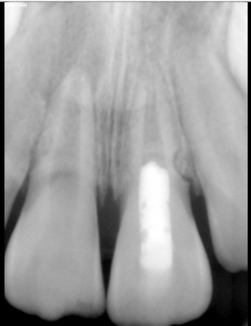 Digital X-ray of a tooth