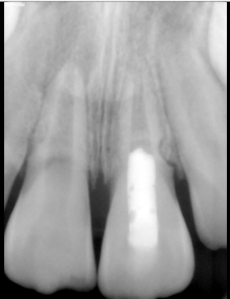 Digital X-ray of a tooth