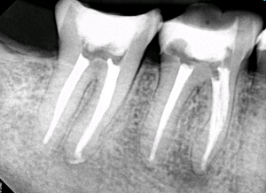 Digital X-ray of a tooth