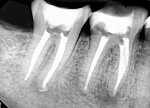 Digital X-ray of a tooth