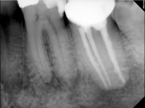 Digital X-ray of a tooth
