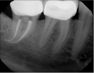 Digital X-ray of a tooth