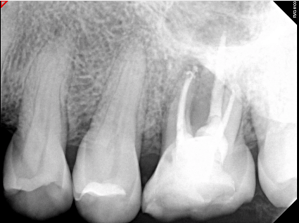 Digital X-ray of a tooth
