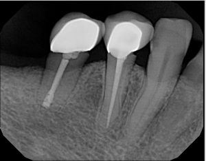 Galería de endodoncia