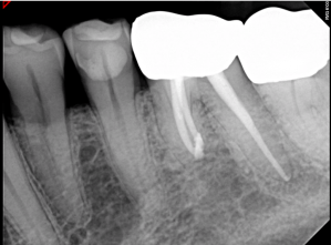 Digital X-ray of a tooth