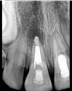 Digital X-ray of a tooth