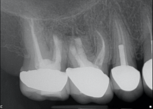 Digital X-ray of a tooth