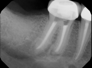 Digital X-ray of a tooth