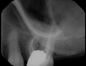 Digital X-ray of a tooth