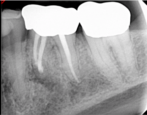 Digital X-ray of a tooth