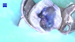 Photo of a cracked tooth
