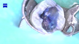 Photo of a cracked tooth