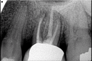 Digital X-ray of a tooth