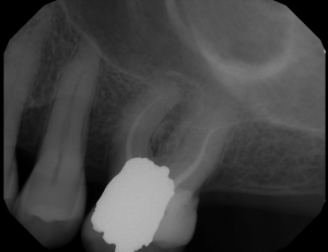Digital X-ray of a tooth