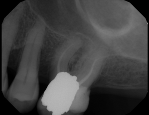 Digital X-ray of a tooth