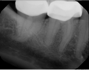 Digital X-ray of a tooth
